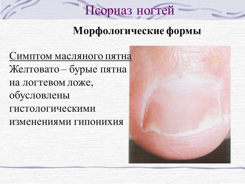 Морфологические формы Псориаз ногтей Пятнистая форма – под ногтевой пластинкой красноватые пятна, несколько миллиметров